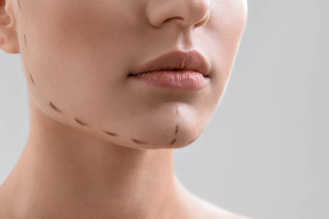 Woman with preoperative surgical markings on her face before a cosmetic procedure