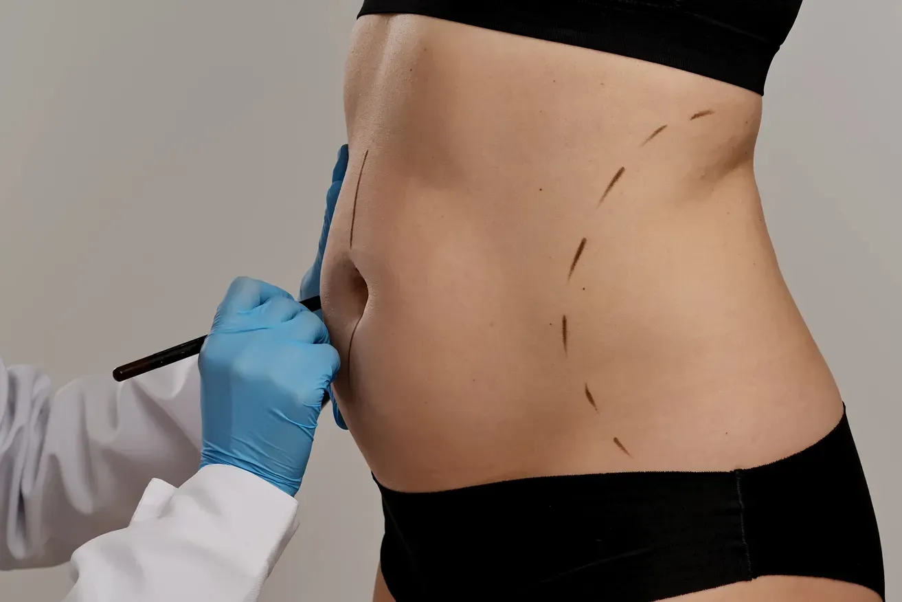 Plastic surgeon drawing preoperative markings on a woman's abdomen